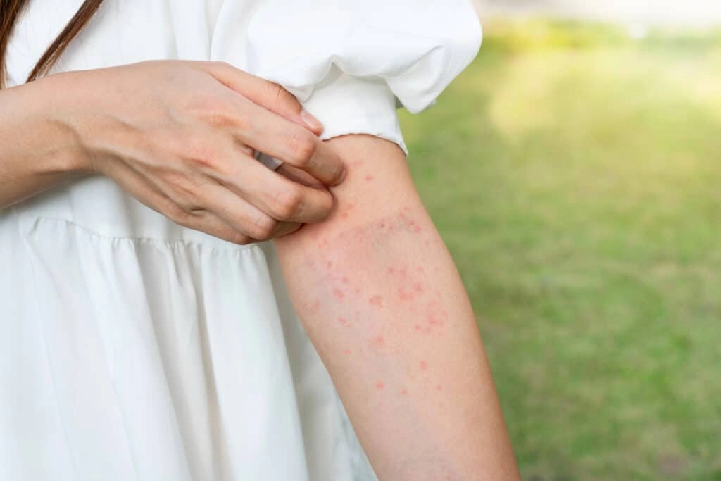 Imate li alergiju na sunce: Evo koji su simptomi i kako ih prirodno eliminirati